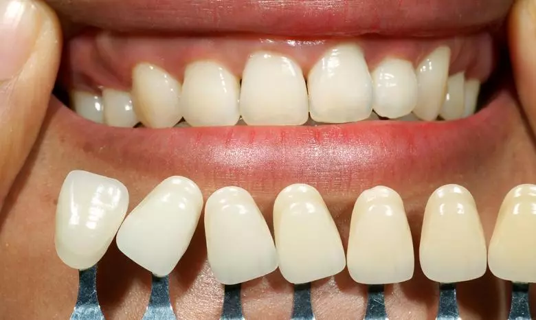 Diş Beyazlatma (Bleaching) Nedir? - Özel Elit Estetik Ağız ve Diş Sağlığı Polikliniği
