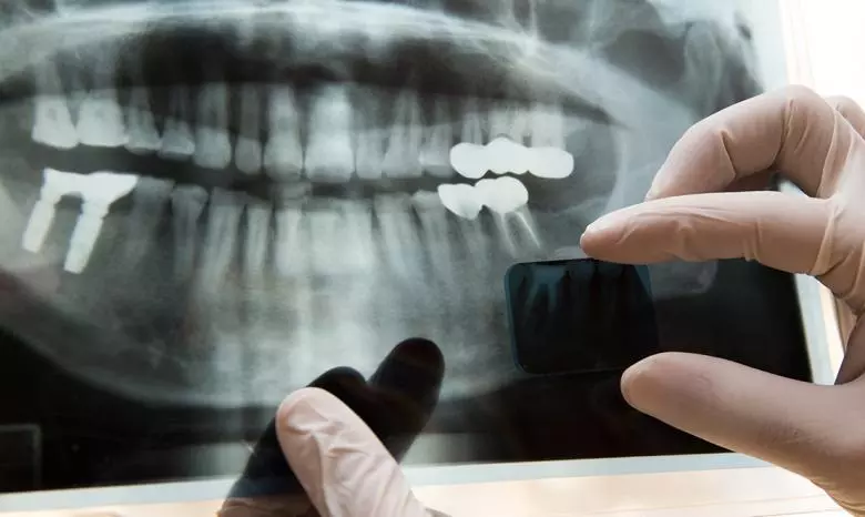 Kanal Tedavisi Nedir? - Özel Elit Estetik Ağız ve Diş Sağlığı Polikliniği