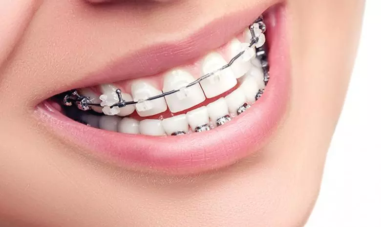 Ortodonti Tedavi Nedir? - Özel Elit Estetik Ağız ve Diş Sağlığı Polikliniği