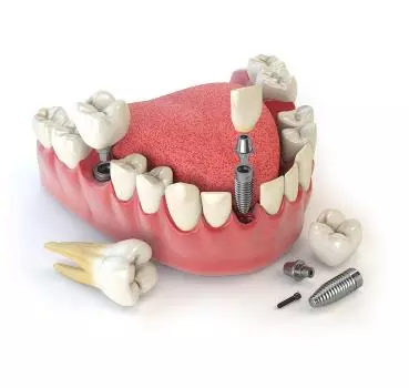 Dental İmplantlar - Özel Elit Estetik Ağız ve Diş Sağlığı Polikliniği