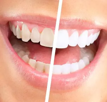 Diş Beyazlatma - Özel Elit Estetik Ağız ve Diş Sağlığı Polikliniği
