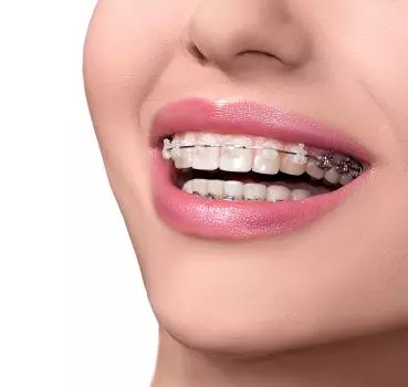 Diş Teli Tedavisi Nedir? - Özel Elit Estetik Ağız ve Diş Sağlığı Polikliniği