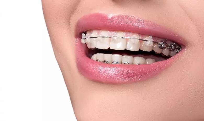 Diş Teli Tedavisi Nedir? - Özel Elit Estetik Ağız ve Diş Sağlığı Polikliniği