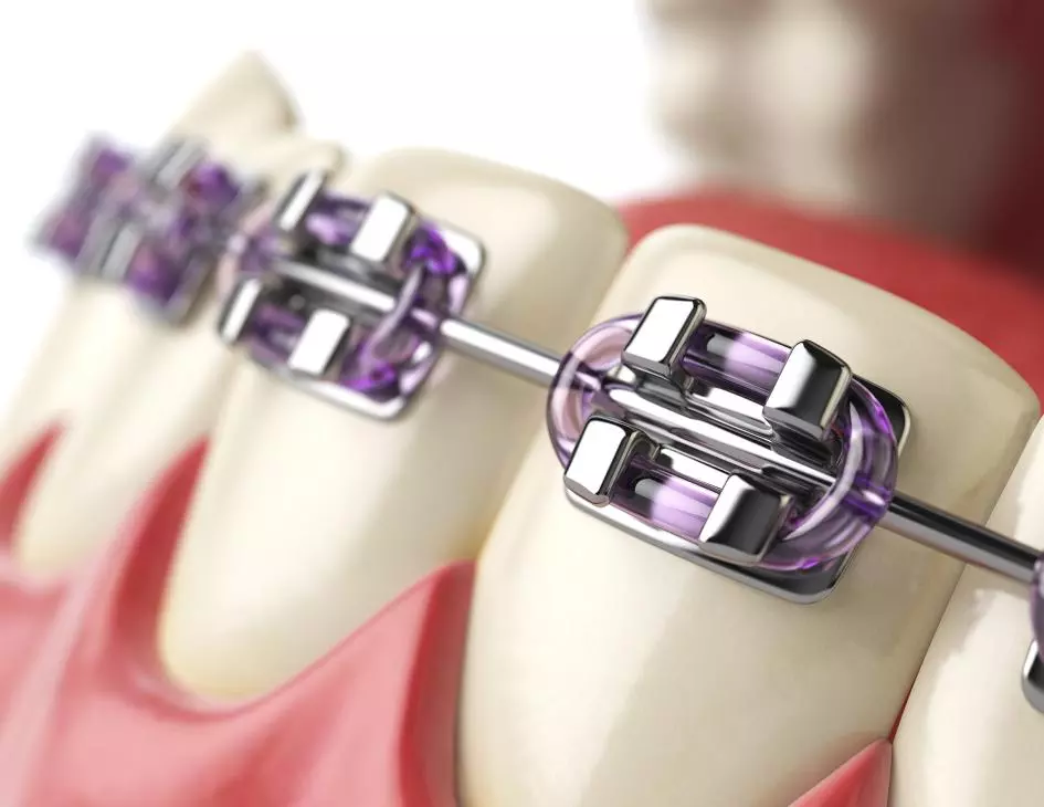 Ortodonti Tedavisi - Özel Elit Estetik Ağız ve Diş Sağlığı Polikliniği