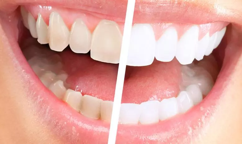 Diş Beyazlatma - Özel Elit Estetik Ağız ve Diş Sağlığı Polikliniği