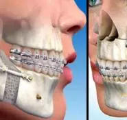 Ortognatik Cerrahi Ve Ortodonti - Özel Elit Estetik Ağız ve Diş Sağlığı Polikliniği