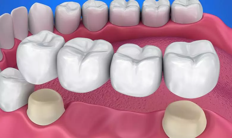 Porselen Kron ve Köprüler - Özel Elit Estetik Ağız ve Diş Sağlığı Polikliniği